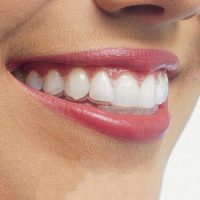 invisalign-estetica